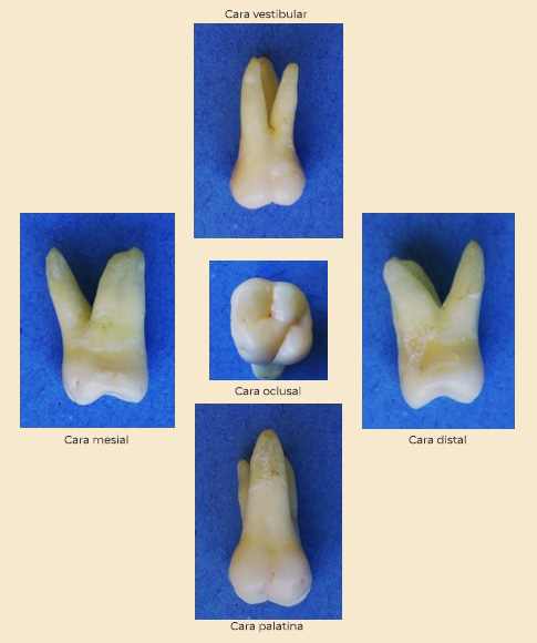 1.2.3 Primer molar superior