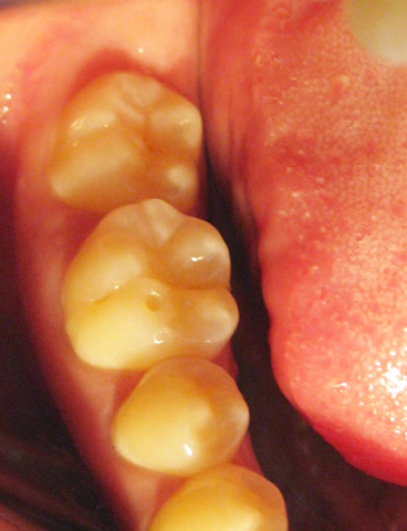 Desgaste dental-erosión, atrición, abrasión, y desgaste dental erosivo