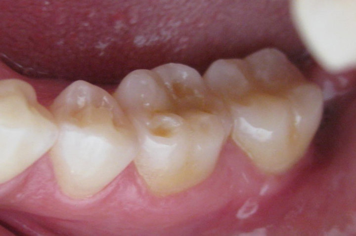 Desgaste dental-erosión, atrición, abrasión, y desgaste dental erosivo