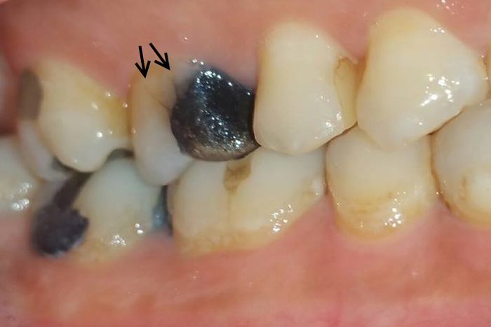 Fracturas dentales