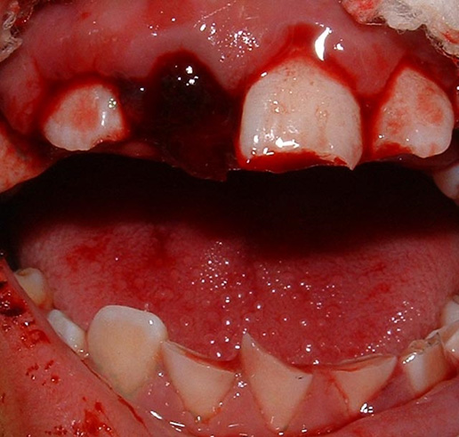 Fracturas dentales