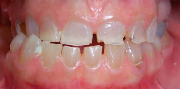 Dentinogénesis imperfecta