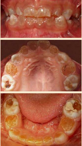 Dentinogénesis imperfecta