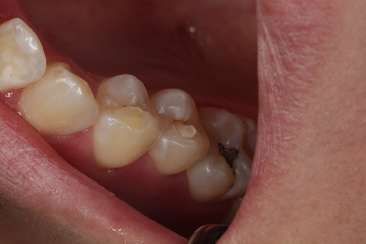 Cúspides accesorias (cúspide en garra y diente evaginado)